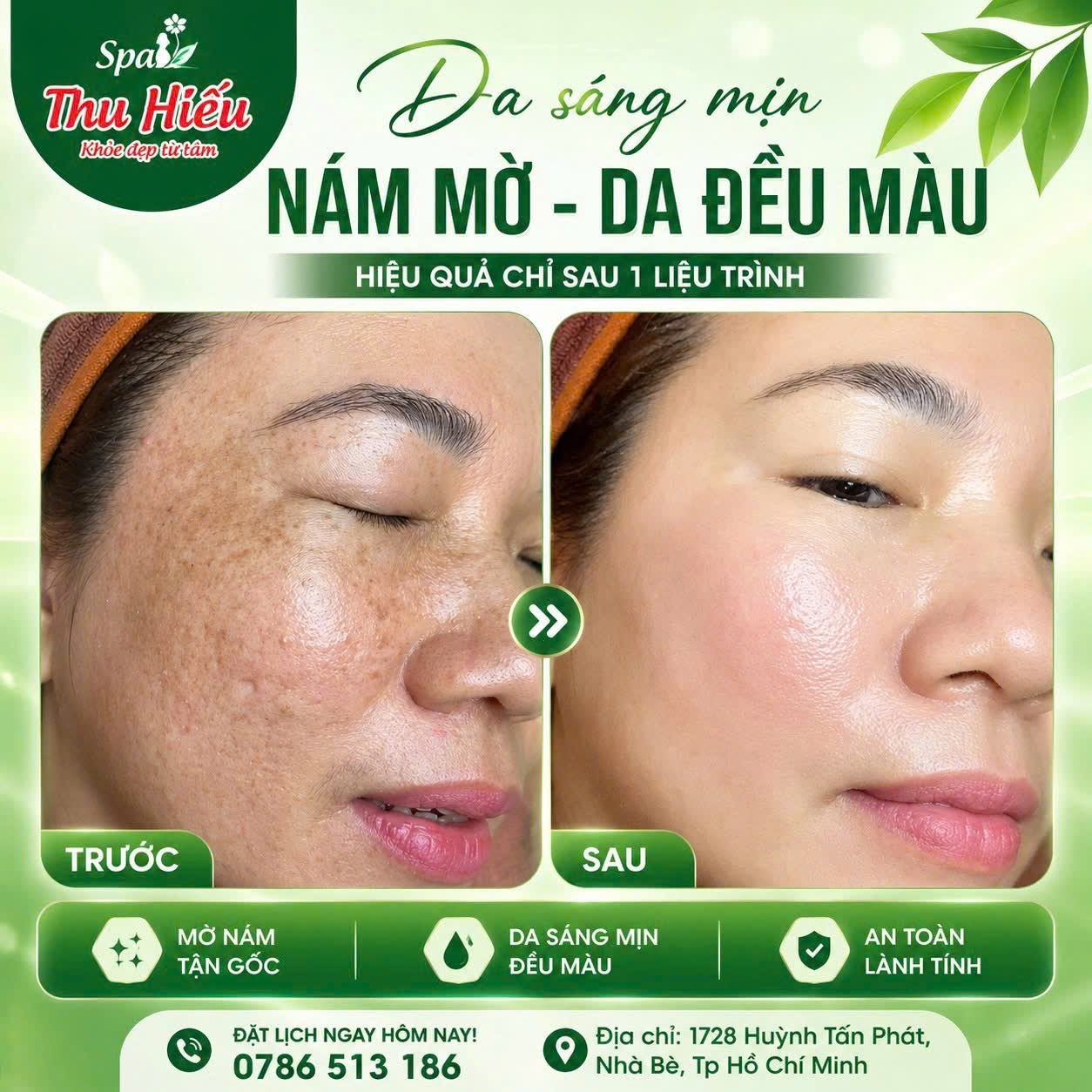 Chăm Sóc Da Mụn, Tàn Nhang Tại Thu Hiếu Spa – Giải Pháp Lấy Lại Làn Da Sáng Khỏe Tự Nhiên